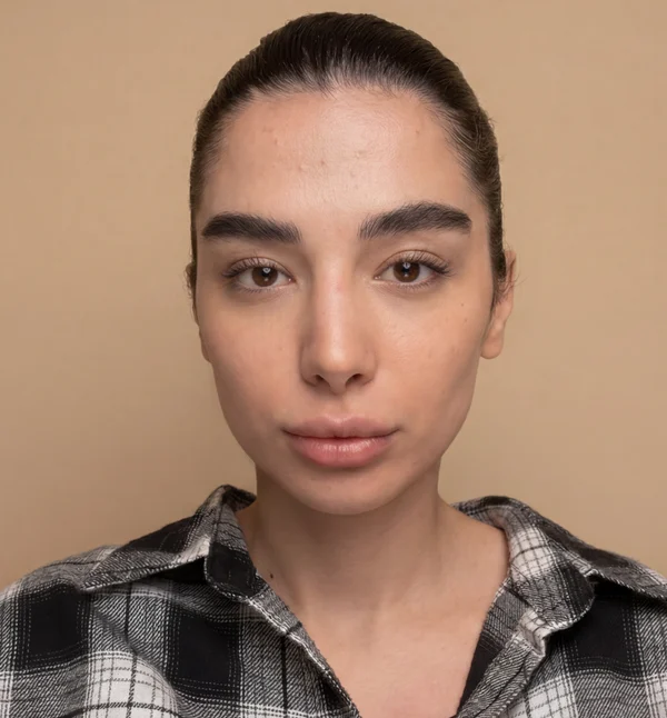 چهره پس از تزریقِ فیلر، نمونهٔ کلینیک لمون