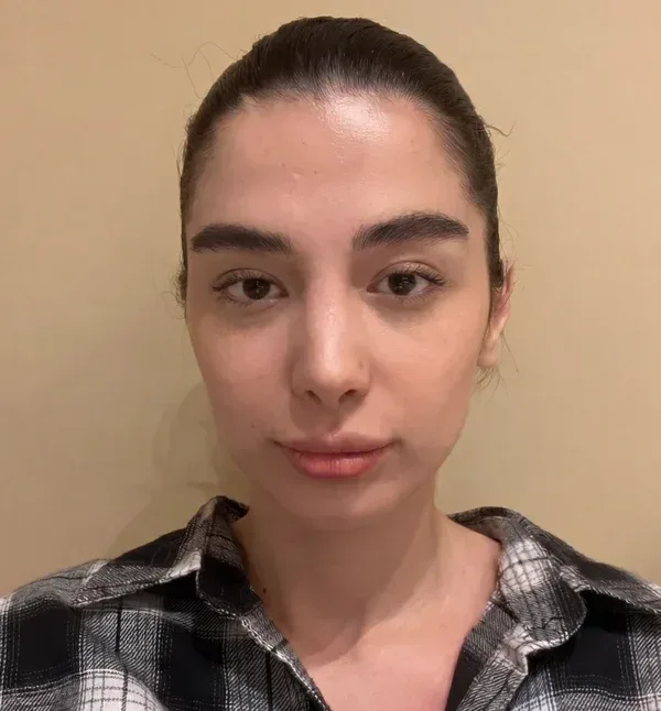 چهره پیش از تزریقِ فیلر، نمونهٔ کلینیک لمون
