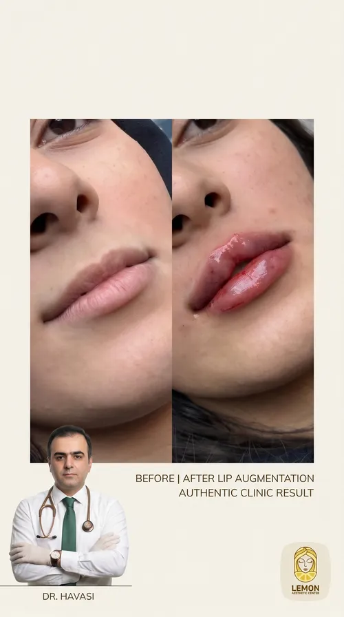 فیلر لب، قبل و بعد در کلینیک زیبایی لمون