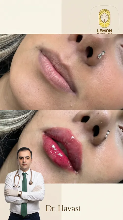فیلر لب، قبل و بعد در کلینیک زیبایی لمون