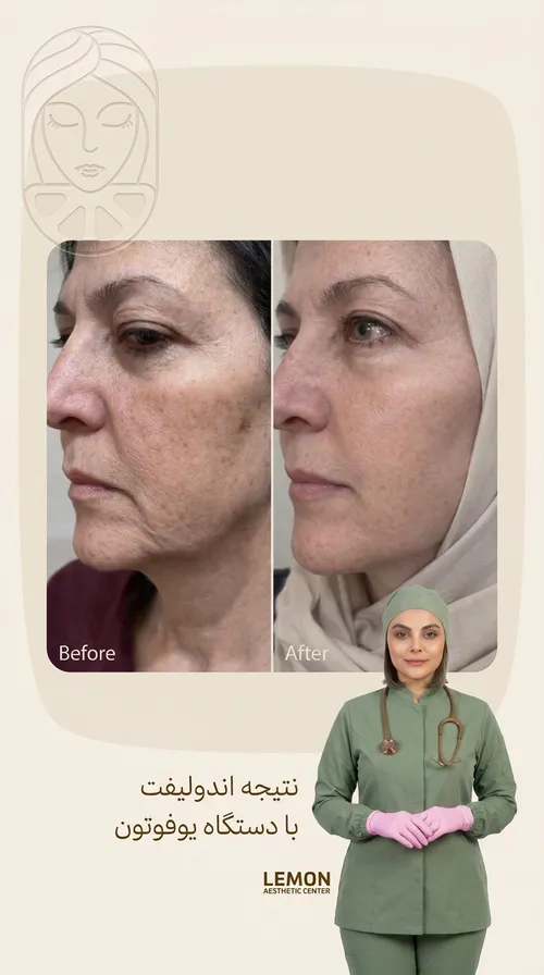 لیفت و اندولیفت، قبل و بعد در کلینیک زیبایی لمون