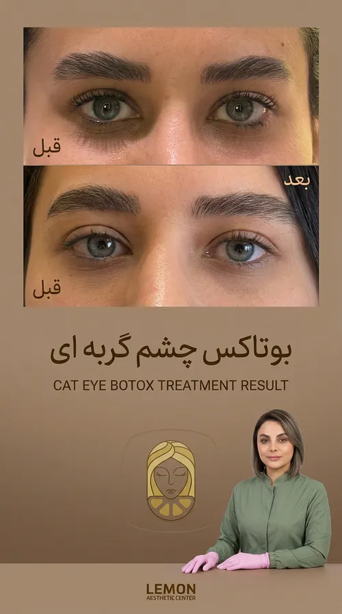 بوتاکس، قبل و بعد در کلینیک زیبایی لمون