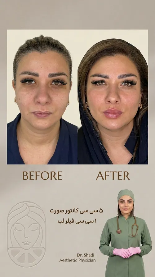 فیلر لب، قبل و بعد در کلینیک زیبایی لمون