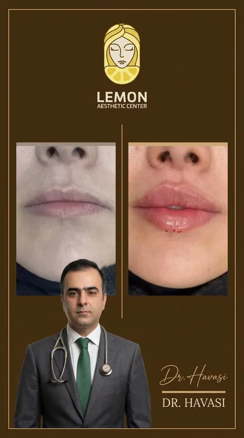 فیلر لب، قبل و بعد در کلینیک زیبایی لمون