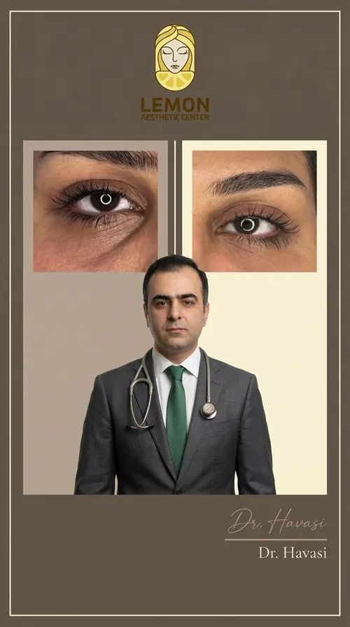 فیلر زیر چشم، قبل و بعد در کلینیک زیبایی لمون