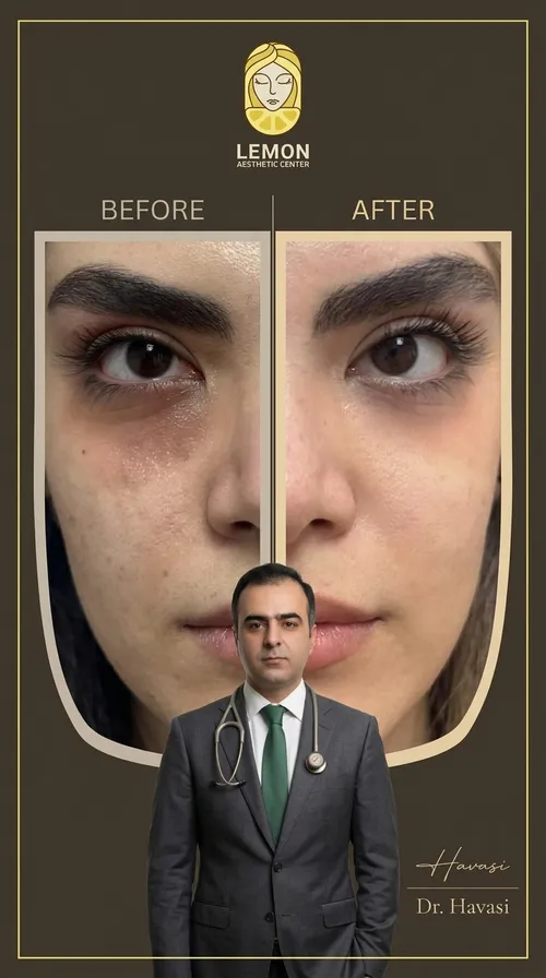 فیلر زیر چشم، قبل و بعد در کلینیک زیبایی لمون