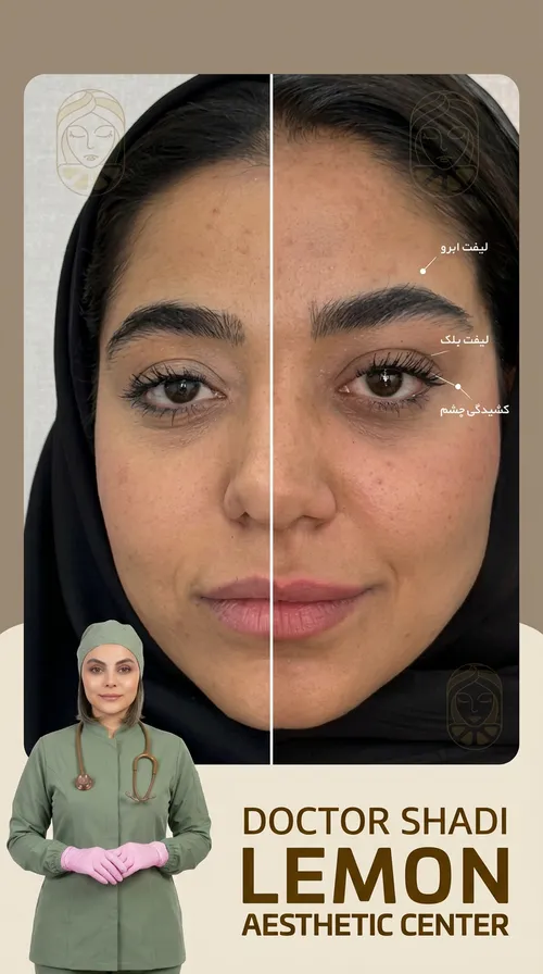 فیلر لب، قبل و بعد در کلینیک زیبایی لمون