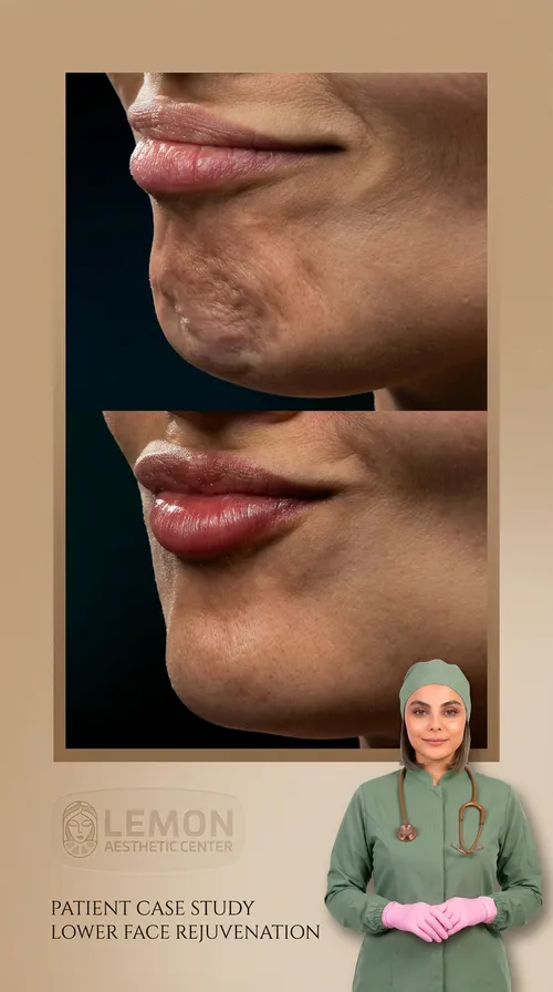 فیلر لب، قبل و بعد در کلینیک زیبایی لمون