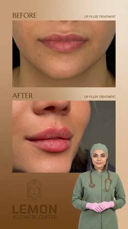 فیلر لب، قبل و بعد در کلینیک زیبایی لمون