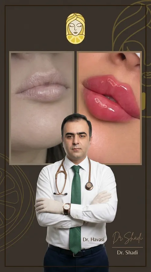فیلر لب، قبل و بعد در کلینیک زیبایی لمون