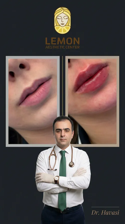 فیلر لب، قبل و بعد در کلینیک زیبایی لمون