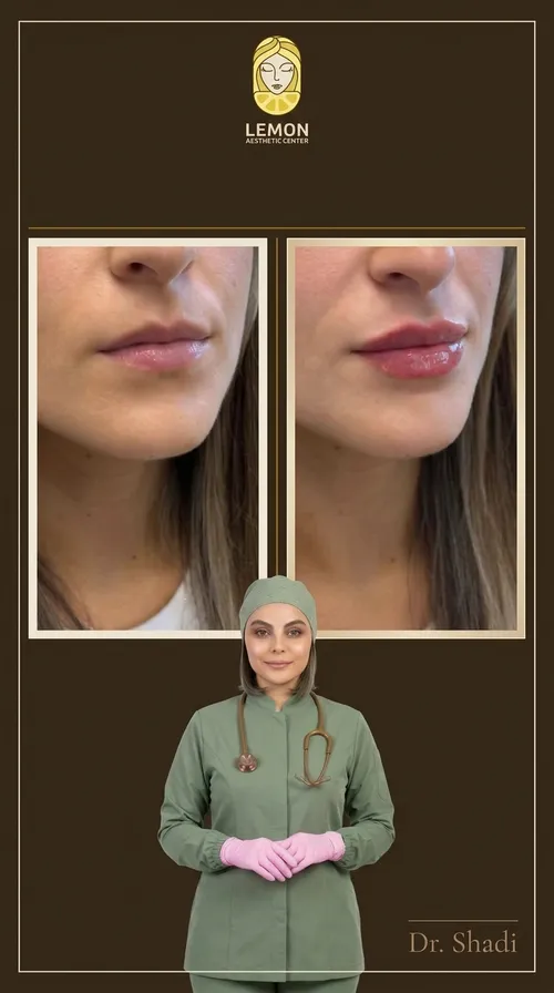 فیلر لب، قبل و بعد در کلینیک زیبایی لمون