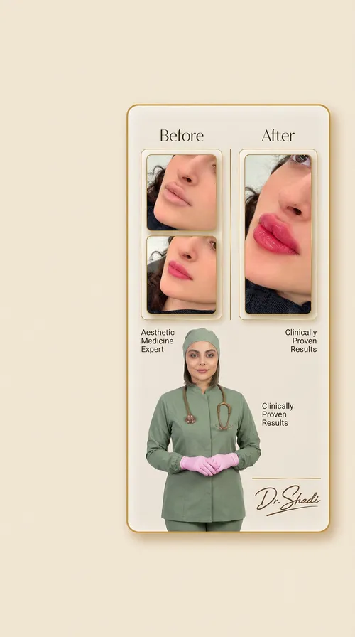 فیلر لب، قبل و بعد در کلینیک زیبایی لمون