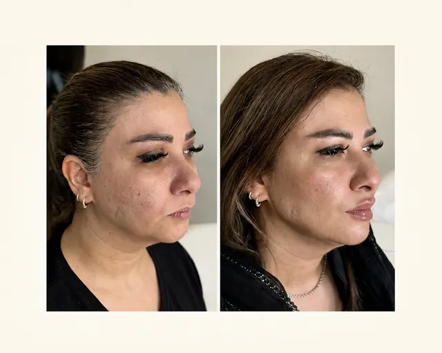 میدفیس و فیلر لب، قبل و بعد در کلینیک زیبایی لمون