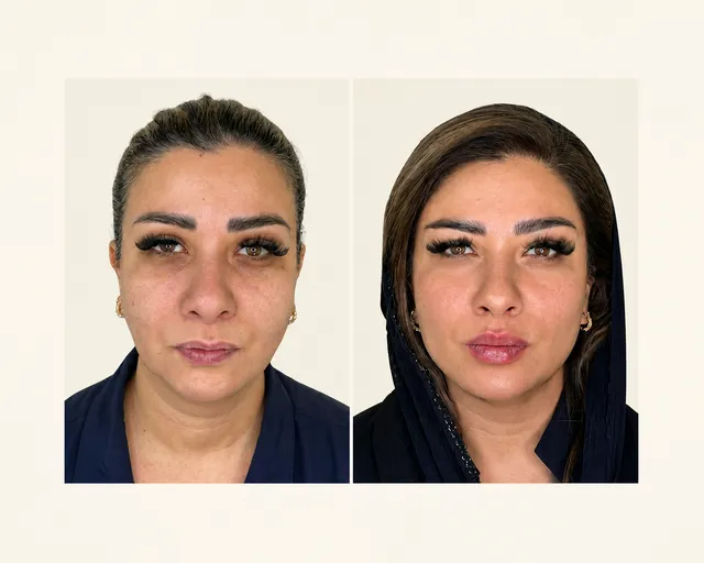 میدفیس و فیلر لب، قبل و بعد در کلینیک زیبایی لمون