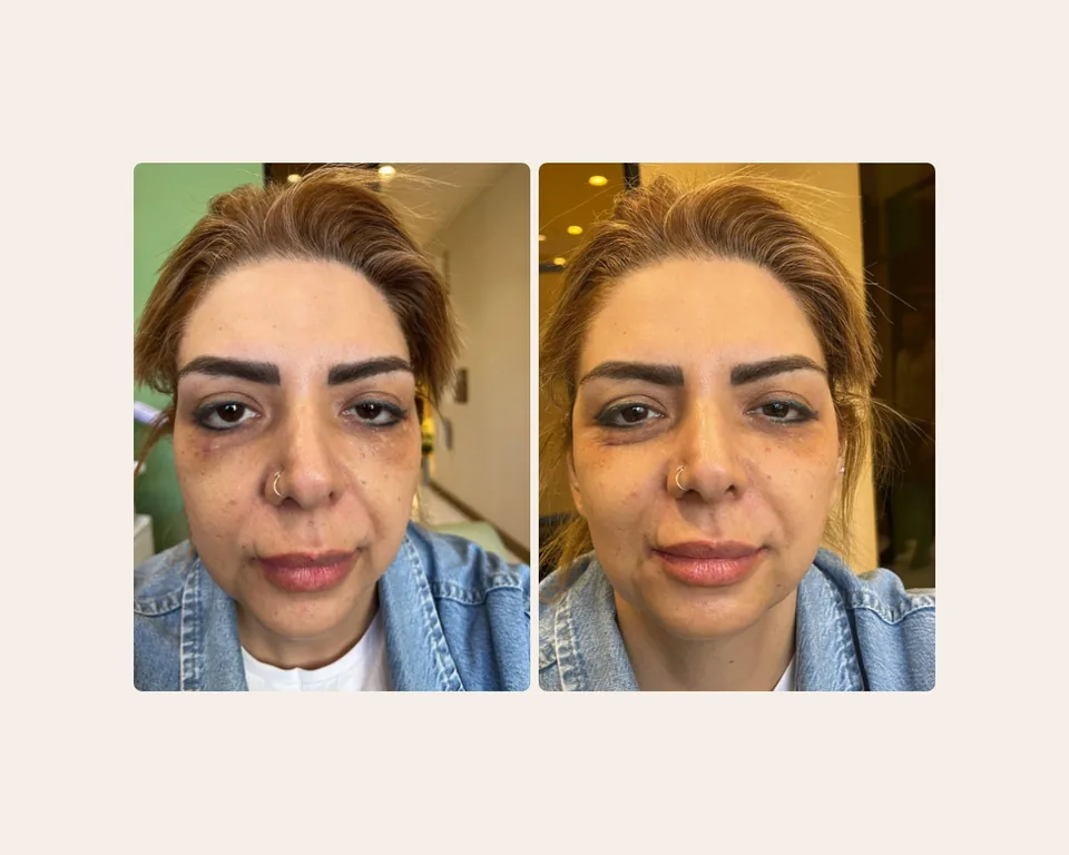 اصلاح تقارن صورت، قبل و بعد در کلینیک زیبایی لمون، توسط دکتر حیدری