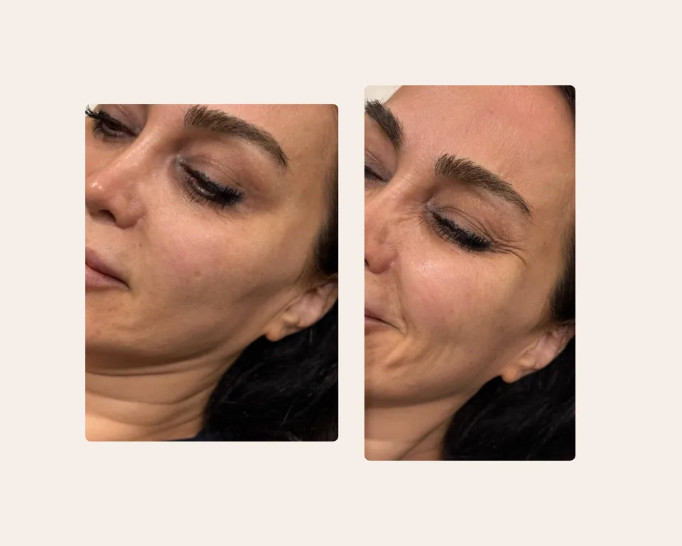 بوتاکس پنجه کلاغی، قبل و بعد در کلینیک زیبایی لمون، توسط دکتر غفوری