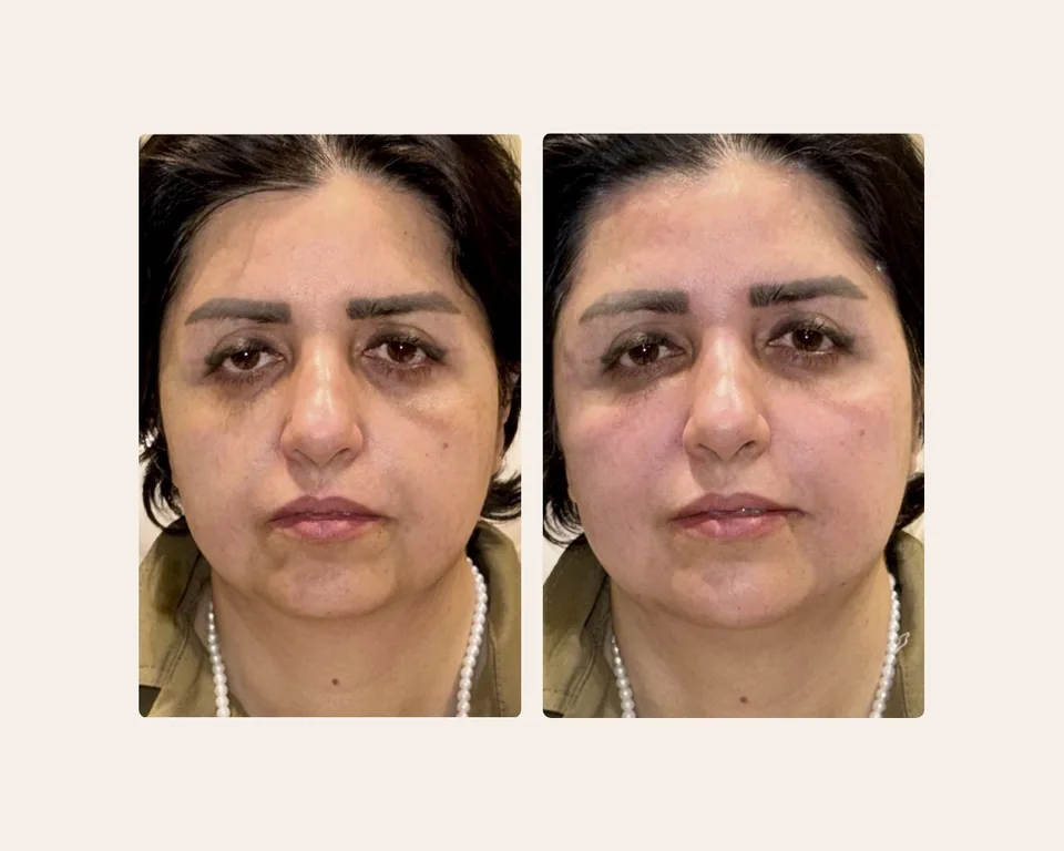 کانتور صورت، قبل و بعد در کلینیک زیبایی لمون، توسط دکتر غفوری