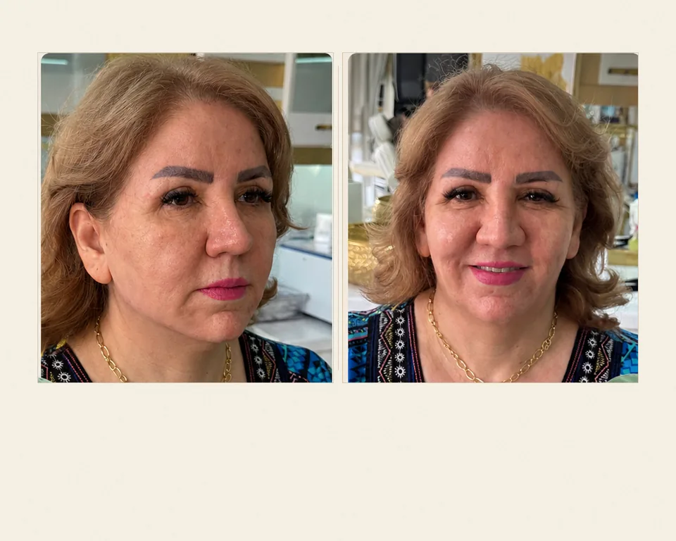 لیفت میدفیس، قبل و بعد در کلینیک زیبایی لمون، توسط دکتر دهقانی