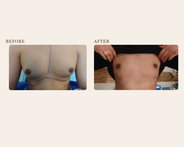 ژنیکوماستی، قبل و بعد در کلینیک زیبایی لمون