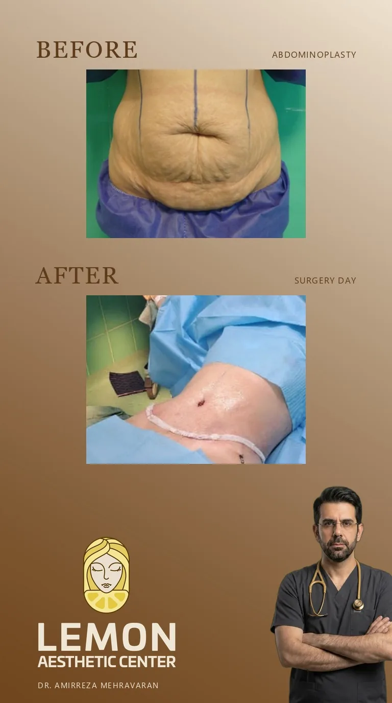 جراحی شکم (ابدومینوپلاستی)