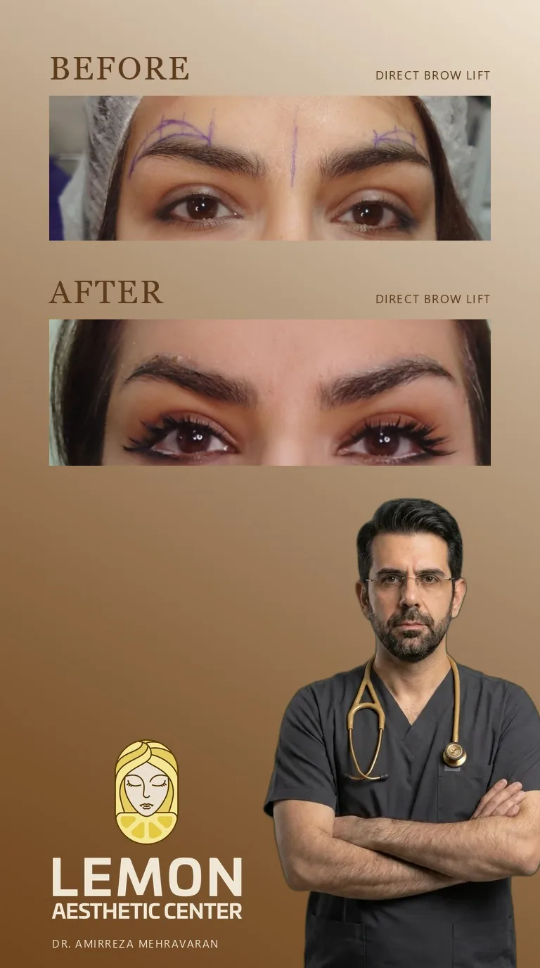 لیفت ابرو (جراحی)