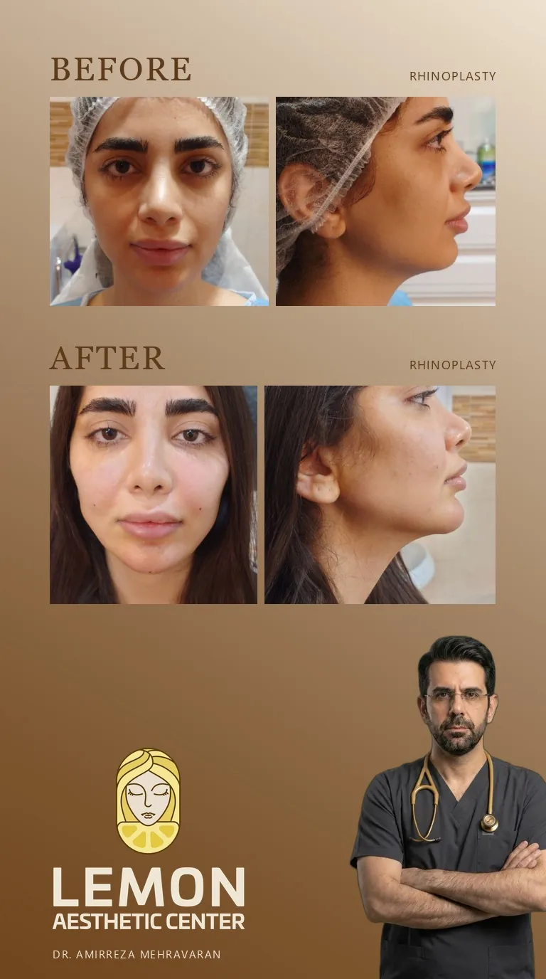 جراحی بینی (رینوپلاستی)